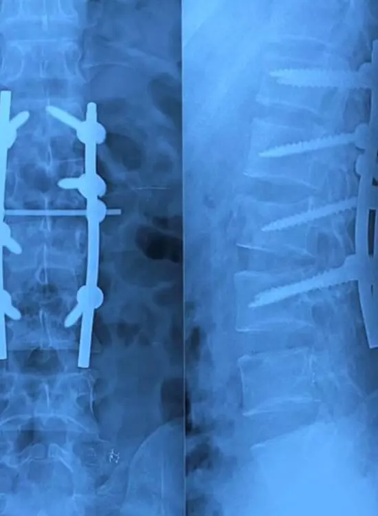 Dr. Alfredo Ortega Quiroz, Cirujano Ortopedista Traumatólogo, Alta Especialidad en Cirugía de Columna Vertebral